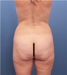 Buttock Lift with Augmentation Before Photo by Marvin Shienbaum, MD; Brandon, FL - Case 46357