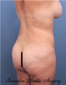 Buttock Lift with Augmentation After Photo by Marvin Shienbaum, MD; Brandon, FL - Case 46357