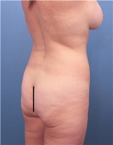 Buttock Lift with Augmentation Before Photo by Marvin Shienbaum, MD; Brandon, FL - Case 46357