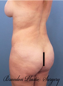 Buttock Lift with Augmentation After Photo by Marvin Shienbaum, MD; Brandon, FL - Case 46357