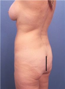 Buttock Lift with Augmentation Before Photo by Marvin Shienbaum, MD; Brandon, FL - Case 46357