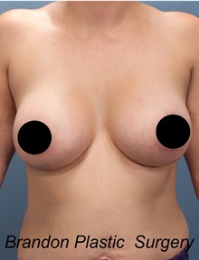 Breast Augmentation After Photo by Marvin Shienbaum, MD; Brandon, FL - Case 46358