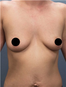 Breast Augmentation Before Photo by Marvin Shienbaum, MD; Brandon, FL - Case 46358