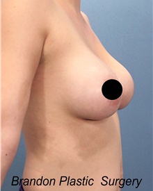 Breast Augmentation After Photo by Marvin Shienbaum, MD; Brandon, FL - Case 46358