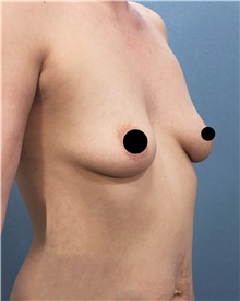 Breast Augmentation Before Photo by Marvin Shienbaum, MD; Brandon, FL - Case 46358