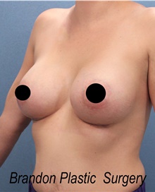 Breast Augmentation After Photo by Marvin Shienbaum, MD; Brandon, FL - Case 46358