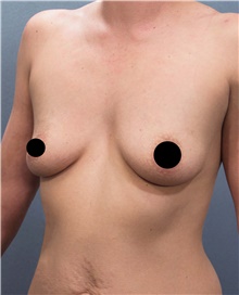 Breast Augmentation Before Photo by Marvin Shienbaum, MD; Brandon, FL - Case 46358