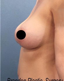 Breast Augmentation After Photo by Marvin Shienbaum, MD; Brandon, FL - Case 46358