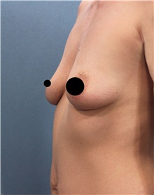 Breast Augmentation Before Photo by Marvin Shienbaum, MD; Brandon, FL - Case 46358