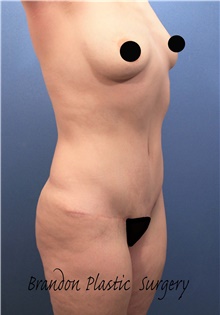 Tummy Tuck After Photo by Marvin Shienbaum, MD; Brandon, FL - Case 46359