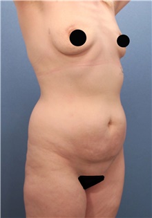 Tummy Tuck Before Photo by Marvin Shienbaum, MD; Brandon, FL - Case 46359