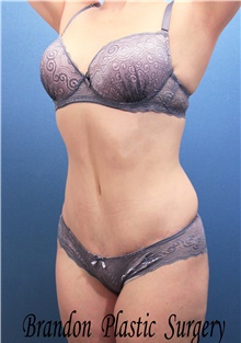 Tummy Tuck After Photo by Marvin Shienbaum, MD; Brandon, FL - Case 46359