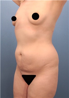 Tummy Tuck Before Photo by Marvin Shienbaum, MD; Brandon, FL - Case 46359