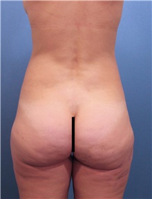 Buttock Lift with Augmentation Before Photo by Marvin Shienbaum, MD; Brandon, FL - Case 46500