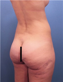 Buttock Lift with Augmentation Before Photo by Marvin Shienbaum, MD; Brandon, FL - Case 46500