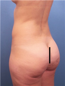 Buttock Lift with Augmentation Before Photo by Marvin Shienbaum, MD; Brandon, FL - Case 46500