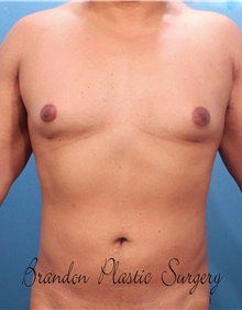 Male Breast Reduction After Photo by Marvin Shienbaum, MD; Brandon, FL - Case 46568