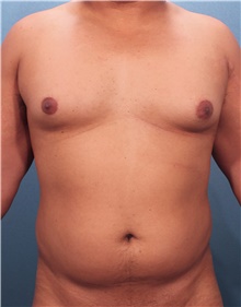 Male Breast Reduction Before Photo by Marvin Shienbaum, MD; Brandon, FL - Case 46568