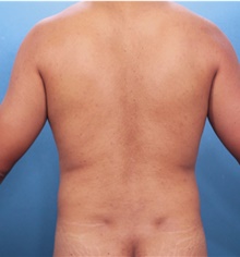 Male Breast Reduction After Photo by Marvin Shienbaum, MD; Brandon, FL - Case 46568