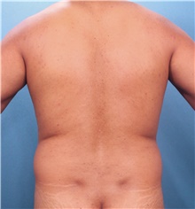 Male Breast Reduction Before Photo by Marvin Shienbaum, MD; Brandon, FL - Case 46568