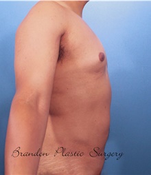 Male Breast Reduction After Photo by Marvin Shienbaum, MD; Brandon, FL - Case 46568