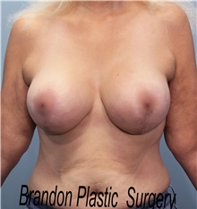 Breast Lift After Photo by Marvin Shienbaum, MD; Brandon, FL - Case 46569