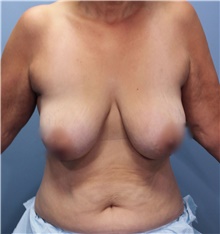 Breast Lift Before Photo by Marvin Shienbaum, MD; Brandon, FL - Case 46569