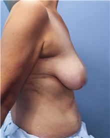 Breast Lift Before Photo by Marvin Shienbaum, MD; Brandon, FL - Case 46569