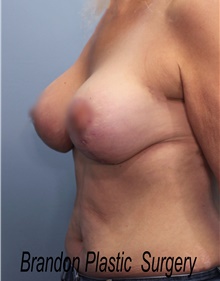 Breast Lift After Photo by Marvin Shienbaum, MD; Brandon, FL - Case 46569