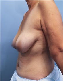 Breast Lift Before Photo by Marvin Shienbaum, MD; Brandon, FL - Case 46569