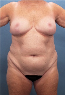 Liposuction Before Photo by Marvin Shienbaum, MD; Brandon, FL - Case 46596