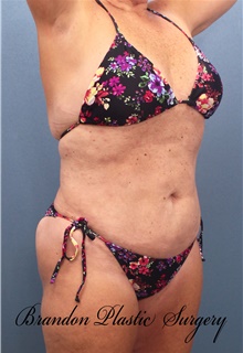 Liposuction After Photo by Marvin Shienbaum, MD; Brandon, FL - Case 46596