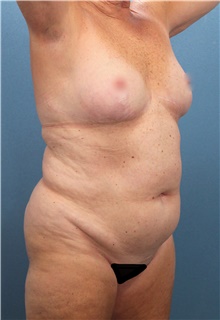 Liposuction Before Photo by Marvin Shienbaum, MD; Brandon, FL - Case 46596