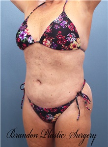 Liposuction After Photo by Marvin Shienbaum, MD; Brandon, FL - Case 46596