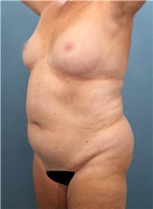 Liposuction Before Photo by Marvin Shienbaum, MD; Brandon, FL - Case 46596