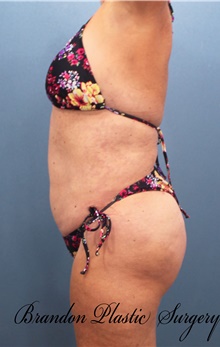 Liposuction After Photo by Marvin Shienbaum, MD; Brandon, FL - Case 46596