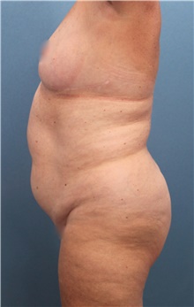 Liposuction Before Photo by Marvin Shienbaum, MD; Brandon, FL - Case 46596