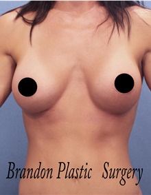 Breast Augmentation After Photo by Marvin Shienbaum, MD; Brandon, FL - Case 46597