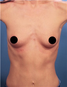 Breast Augmentation Before Photo by Marvin Shienbaum, MD; Brandon, FL - Case 46597