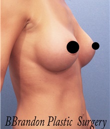 Breast Augmentation After Photo by Marvin Shienbaum, MD; Brandon, FL - Case 46597