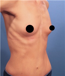 Breast Augmentation Before Photo by Marvin Shienbaum, MD; Brandon, FL - Case 46597