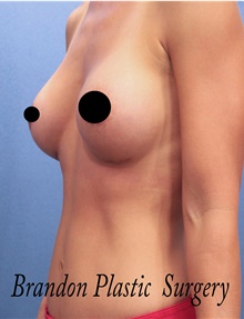 Breast Augmentation After Photo by Marvin Shienbaum, MD; Brandon, FL - Case 46597