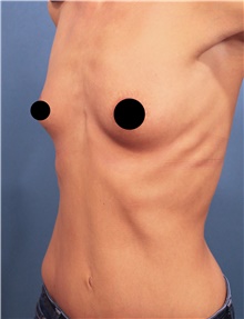 Breast Augmentation Before Photo by Marvin Shienbaum, MD; Brandon, FL - Case 46597