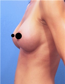 Breast Augmentation After Photo by Marvin Shienbaum, MD; Brandon, FL - Case 46597