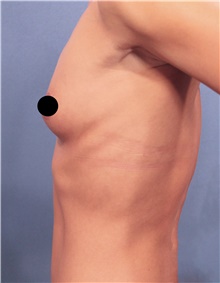 Breast Augmentation Before Photo by Marvin Shienbaum, MD; Brandon, FL - Case 46597