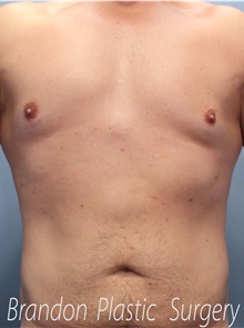 Liposuction After Photo by Marvin Shienbaum, MD; Brandon, FL - Case 46635