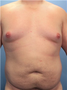 Liposuction Before Photo by Marvin Shienbaum, MD; Brandon, FL - Case 46635