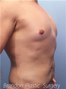 Liposuction After Photo by Marvin Shienbaum, MD; Brandon, FL - Case 46635