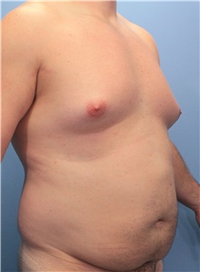 Liposuction Before Photo by Marvin Shienbaum, MD; Brandon, FL - Case 46635