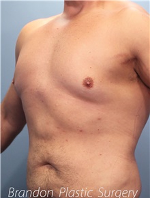 Liposuction After Photo by Marvin Shienbaum, MD; Brandon, FL - Case 46635